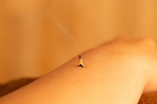 池袋の鍼灸院のお灸施術